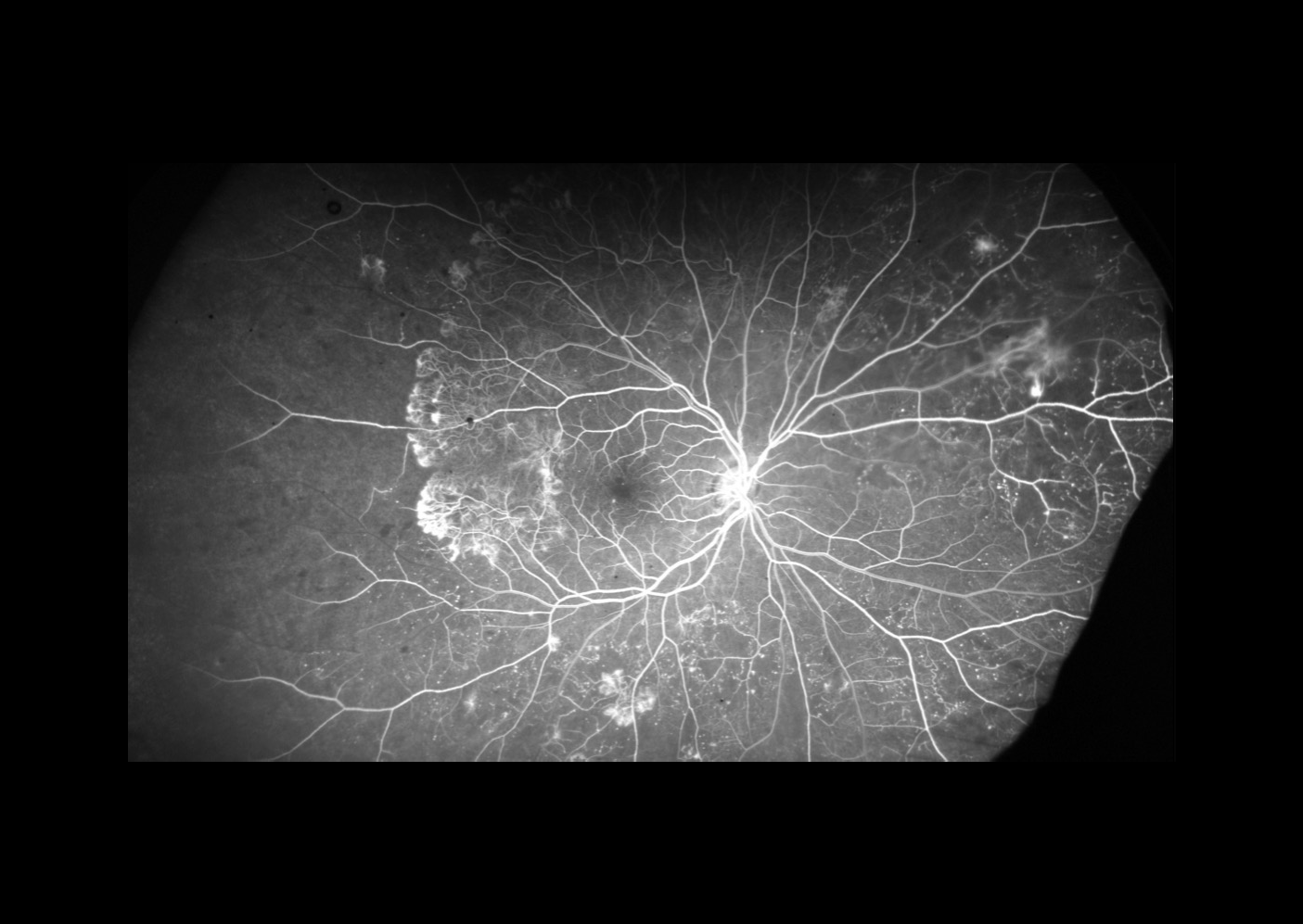 Rétinopathie diabétique Ophtalmologie l Union